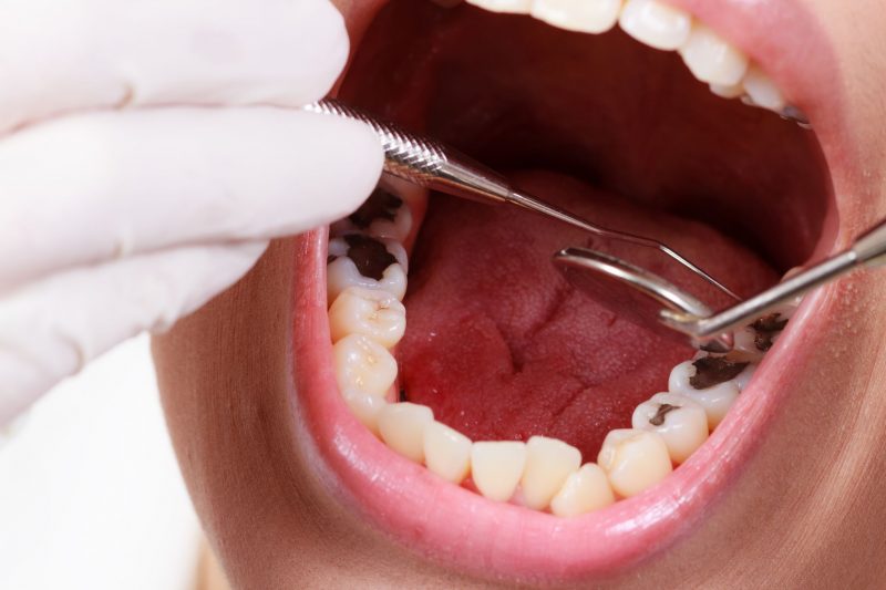 Smile Confidently with Custom Solutions from a Dental Implants Lab Kernersville NC