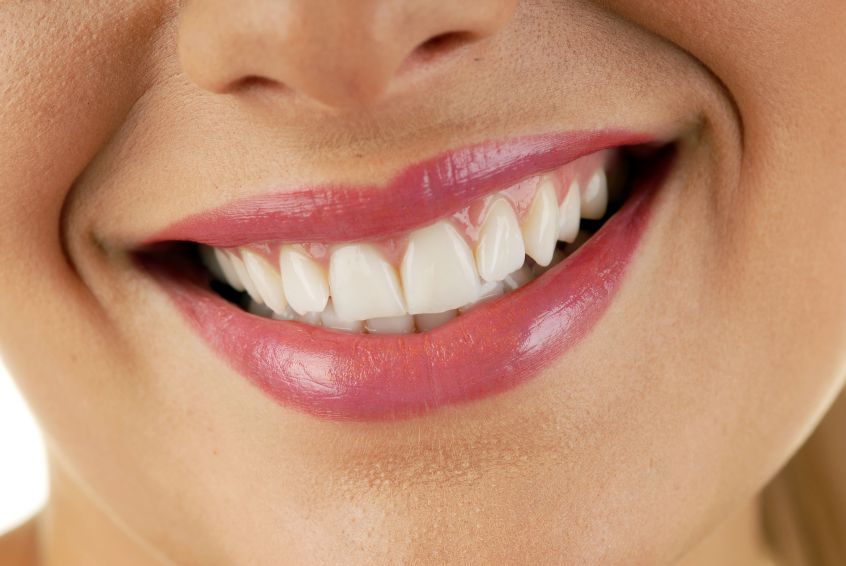 The Beautiful White Smile Of A Teeth Whitening In Birmingham MI