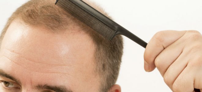 Relevance of Having Hair Restoration as Experienced by New York Residents