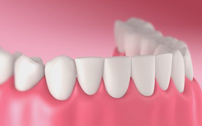 Achieve a Healthier, Straighter Smile with Dental Braces in Crown Point, IN,