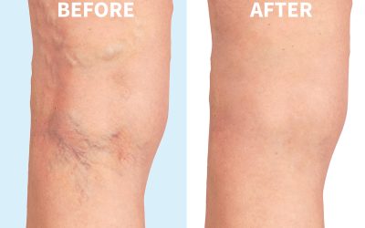 Restore Smooth Skin by Choosing Laser Vein Removal Hoffman Estates IL Clinic Care